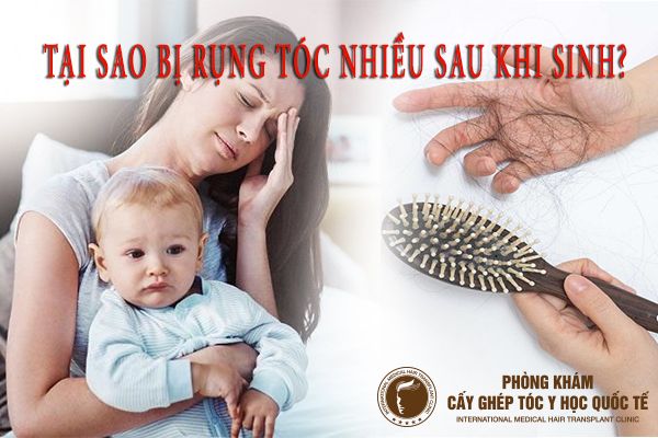 Bí Quyết Giảm Rụng Tóc Sau Sinh: 5 Mẹo Tại Nhà Cho Các Mẹ Bỉm Sữa